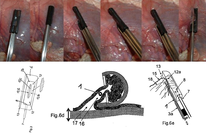 AttachLifter for
            pericardial access (PeriAttacher)